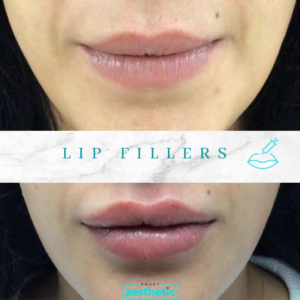 Lip Fillers (1)